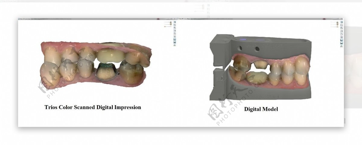 数字化牙颌模型的建立