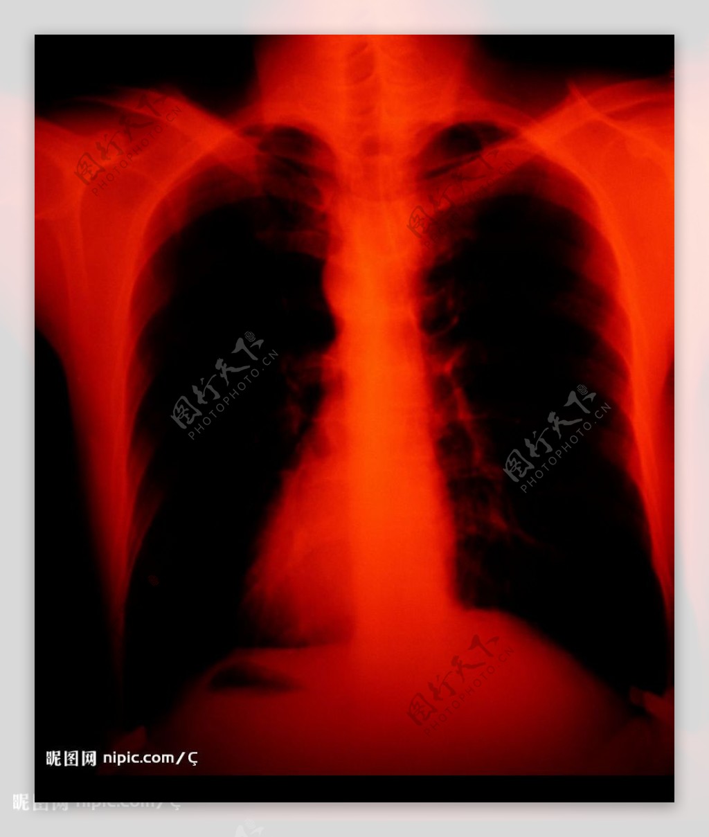 胸的X光图片