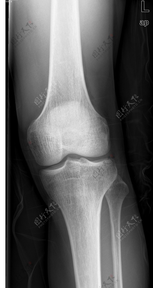 膝盖骨科医生x光图片