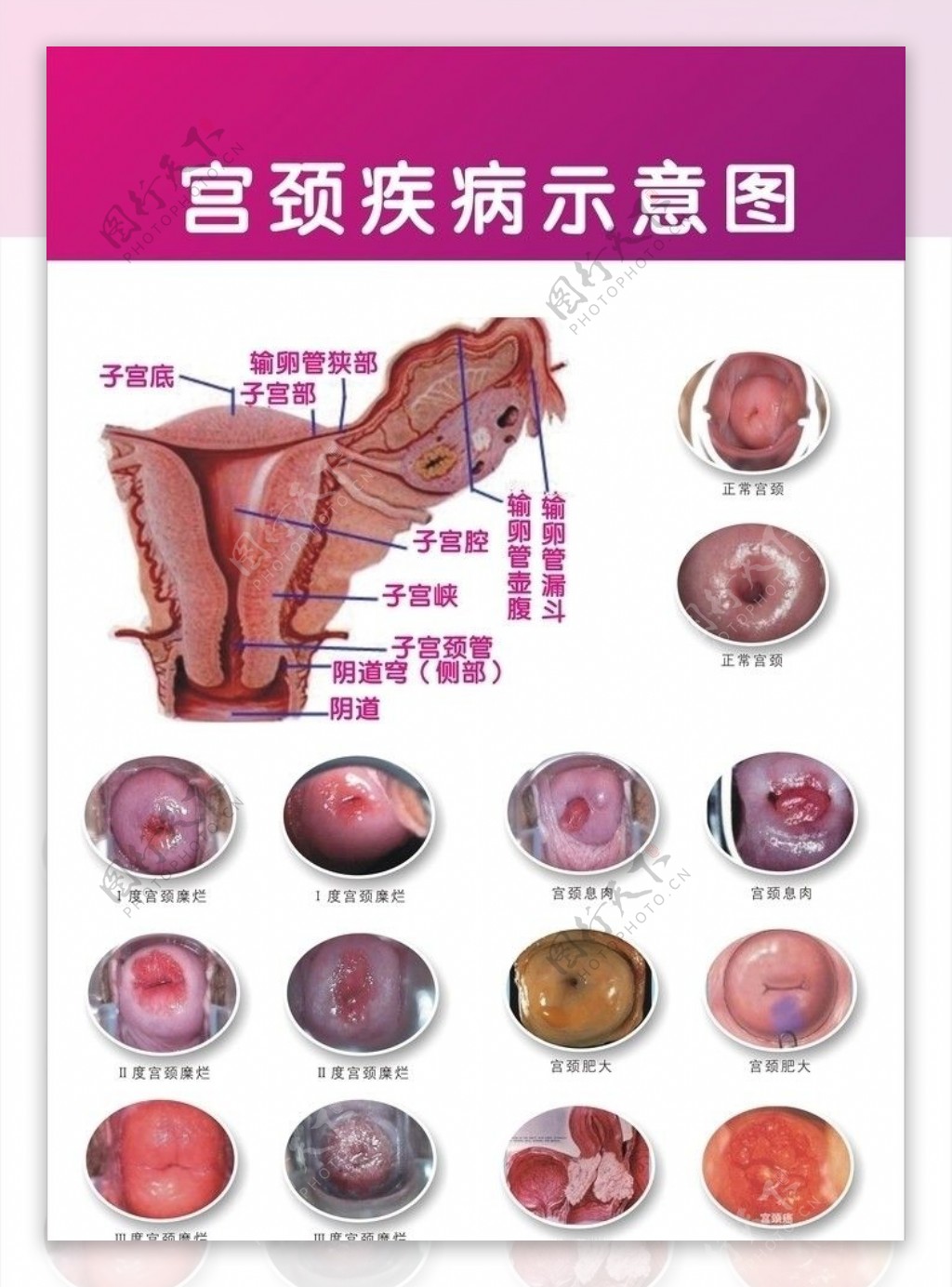 宫颈糜烂图片