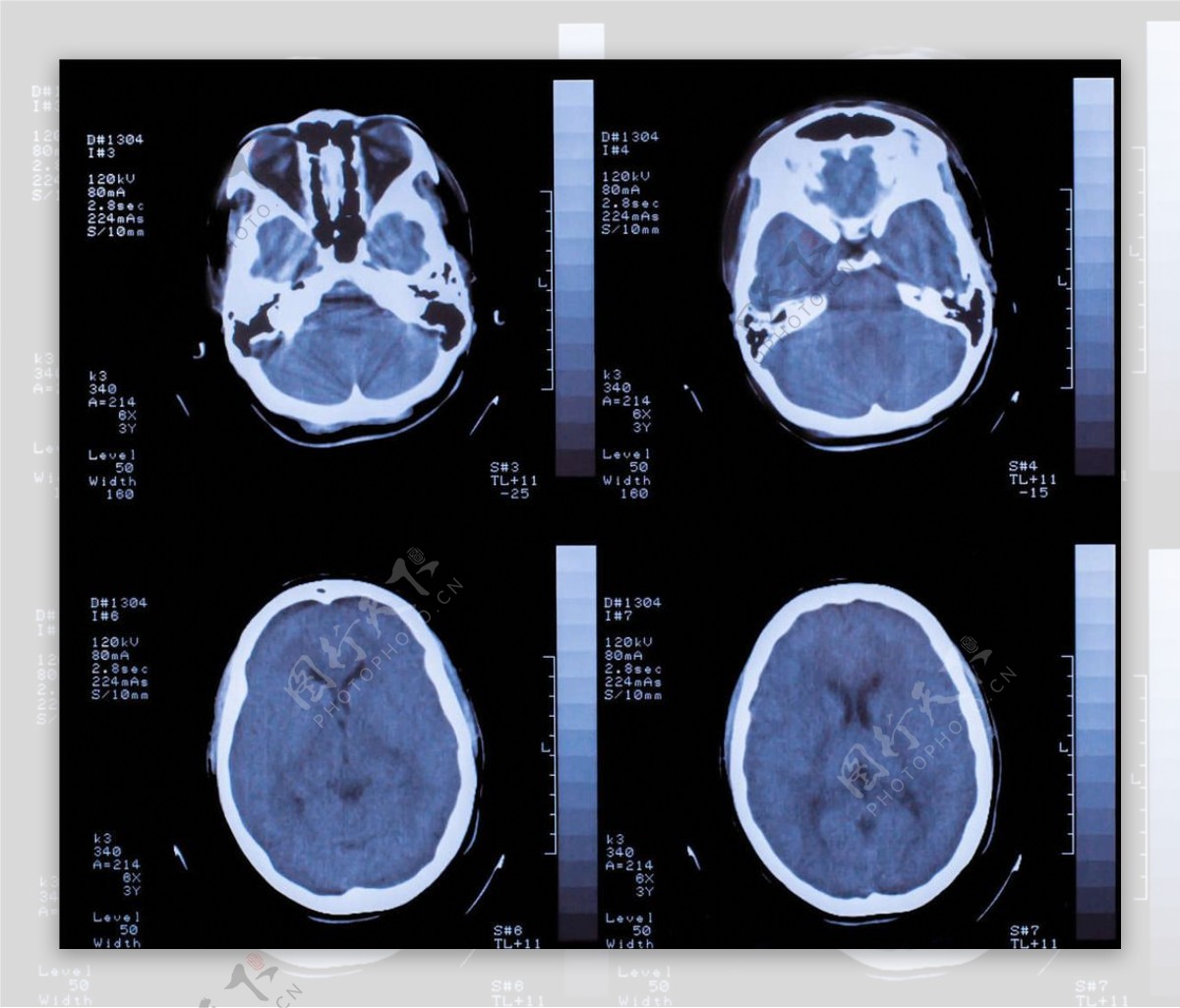大脑X光片图片