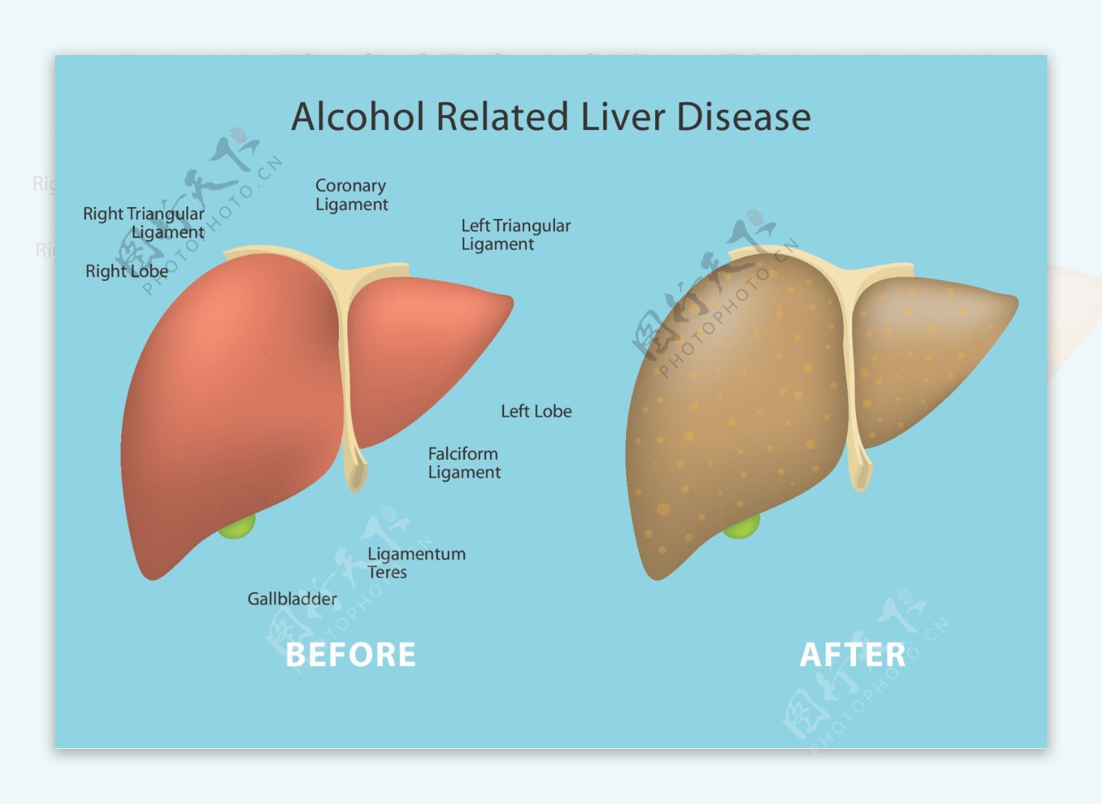 酒精相关的肝脏疾病